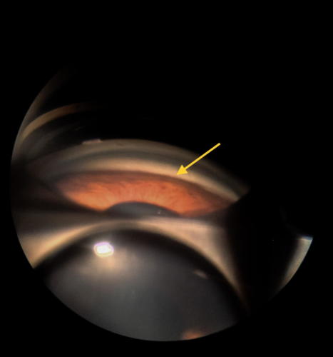 Narrow angle - gonioscopy
